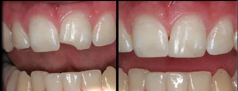 Cosmetic Dental Bonding