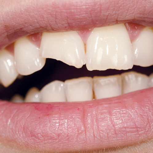 Cosmetic Dental Bonding