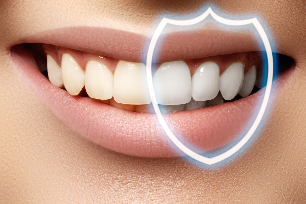 Cosmetic Dental Bonding