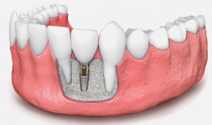 DENTAL IMPLANTS AND ORAL SURGERY