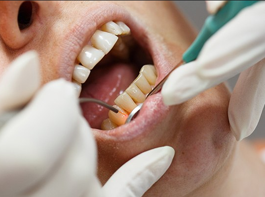 Full Mouth Reconstruction