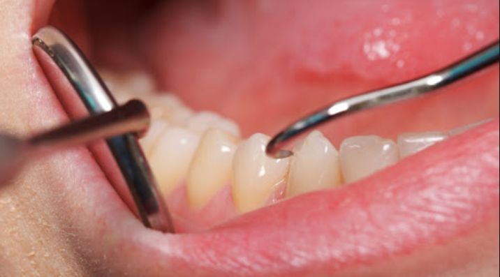 Gum Disease