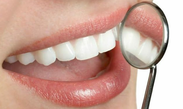Porcelain Veneers