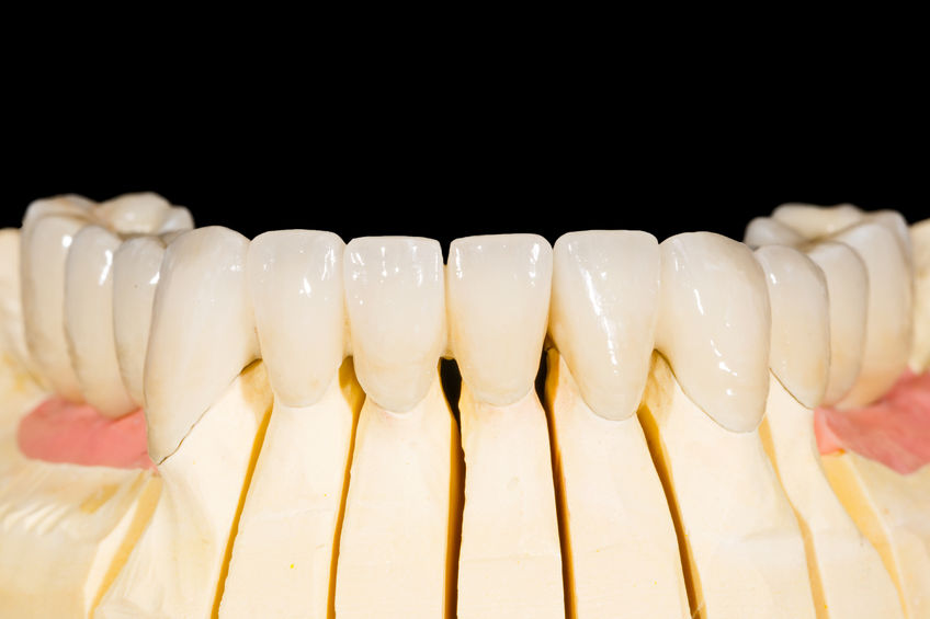 Porcelain Veneers