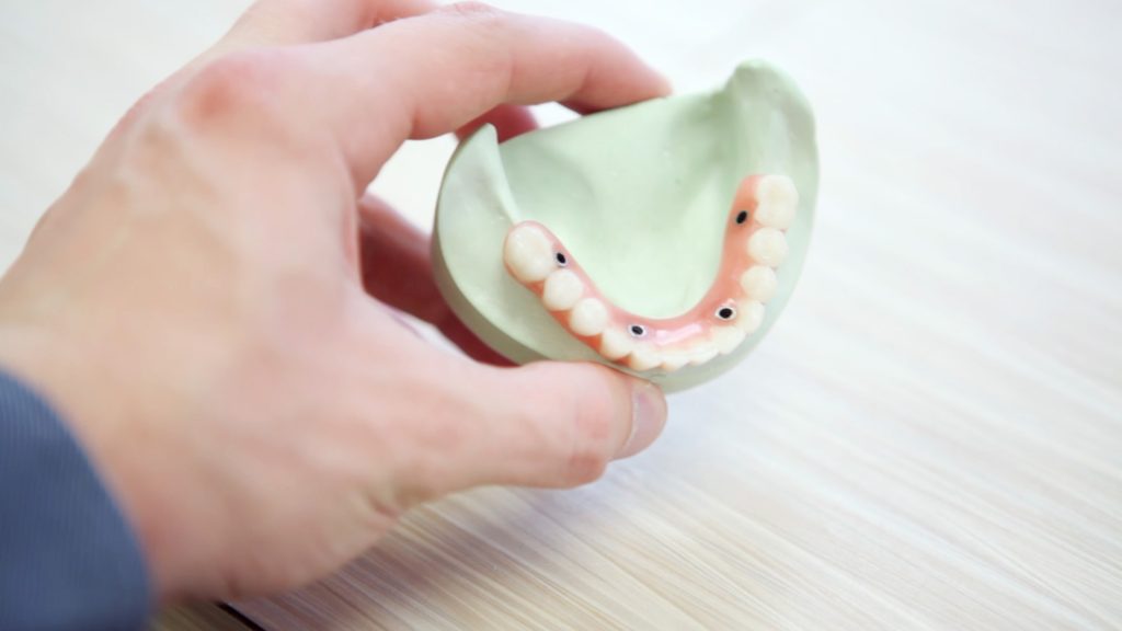 tooth bonding