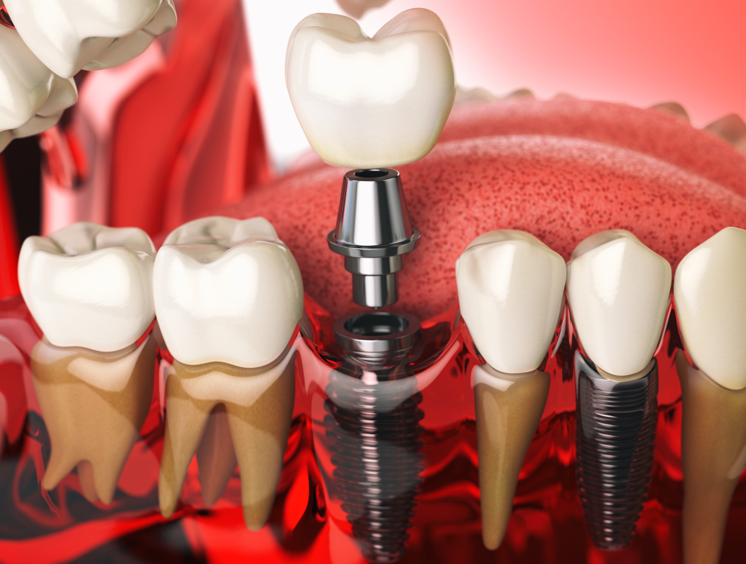 Read more about the article How Do Dental Implants Work?