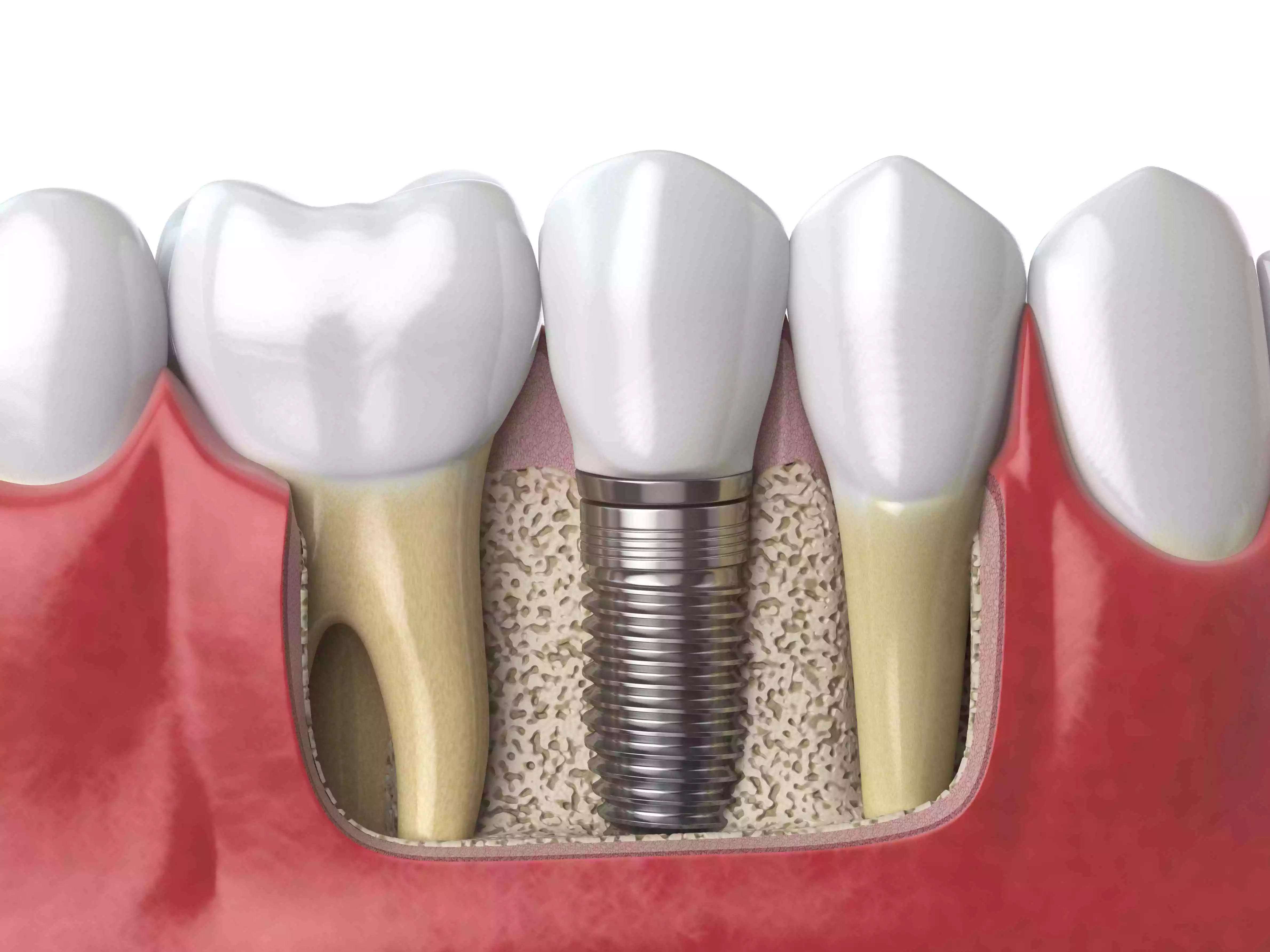 Read more about the article Dental Implant Procedure