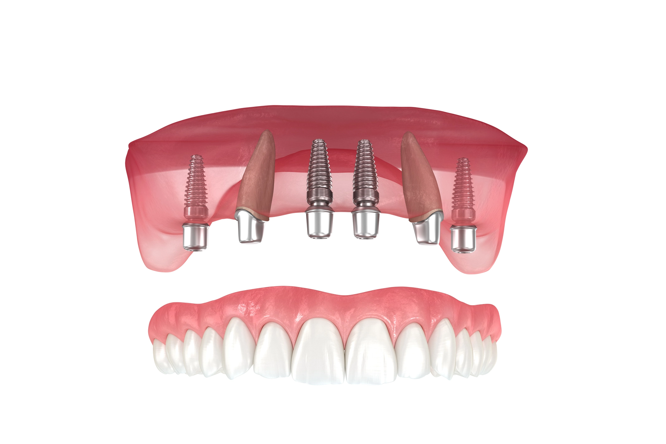 Read more about the article Are All-on-Four Dental Implants Comfortable? Let’s Uncover the Facts!