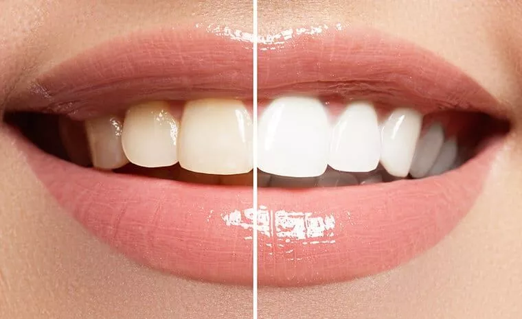 Read more about the article  5 Effective Teeth Whitening Home Remedies