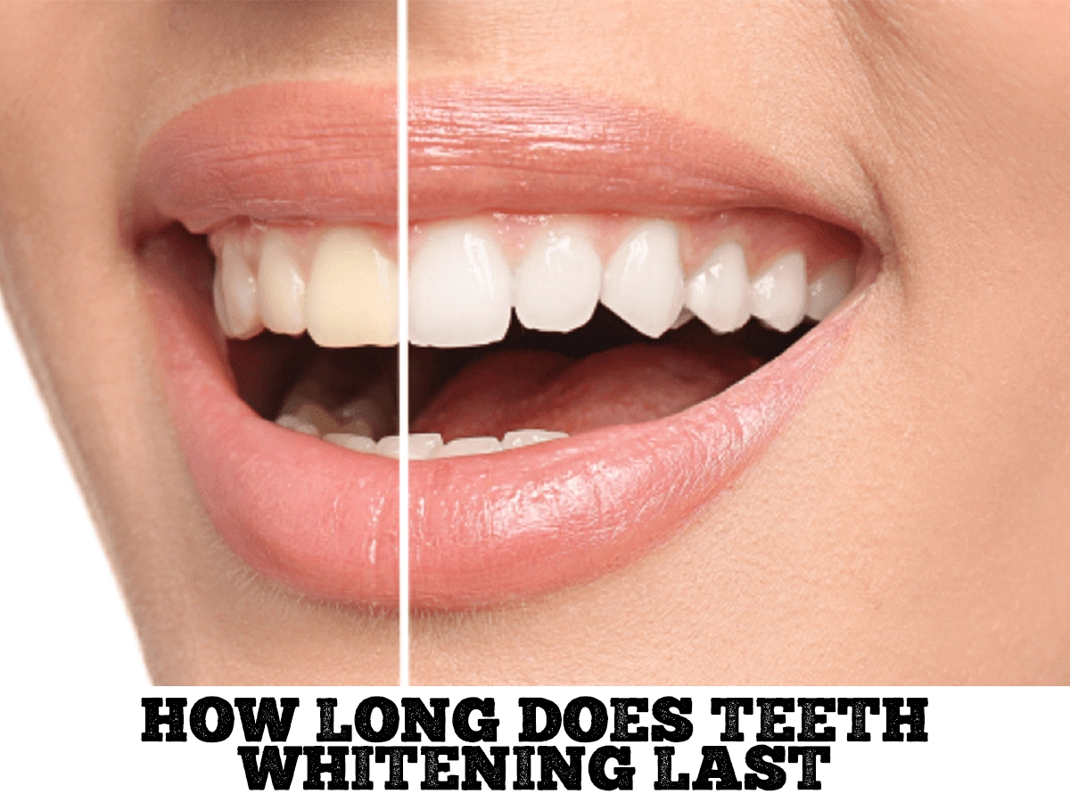 Read more about the article How Long Does Teeth Whitening Last?