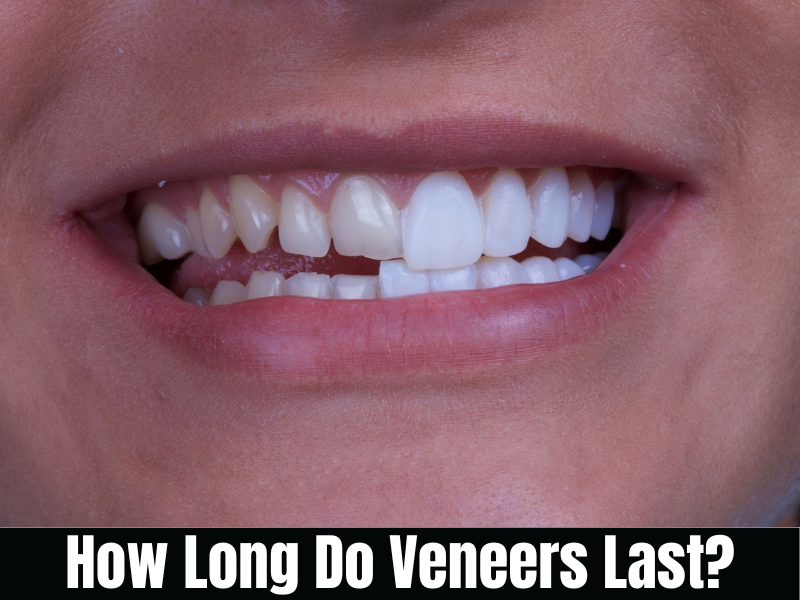Read more about the article How Long Do Veneers Last?